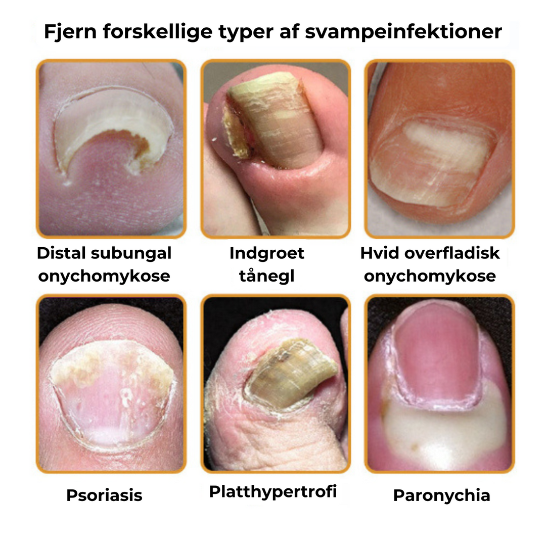 Negleserum mod neglesvamp. Plejer og styrker negle, giver sunde negle og forebygger svamp.