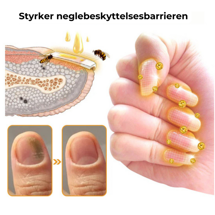 Neglesvamp behandling med Negleskjold serum. Genskaber sunde, stærke negle fri for svamp. Fodpleje.