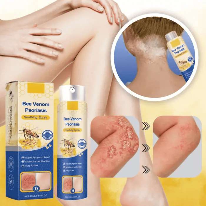 Psoriasis Lindring Spray til hurtig og effektiv hudpleje. Beroliger kløe og rødme for sensitiv hud.