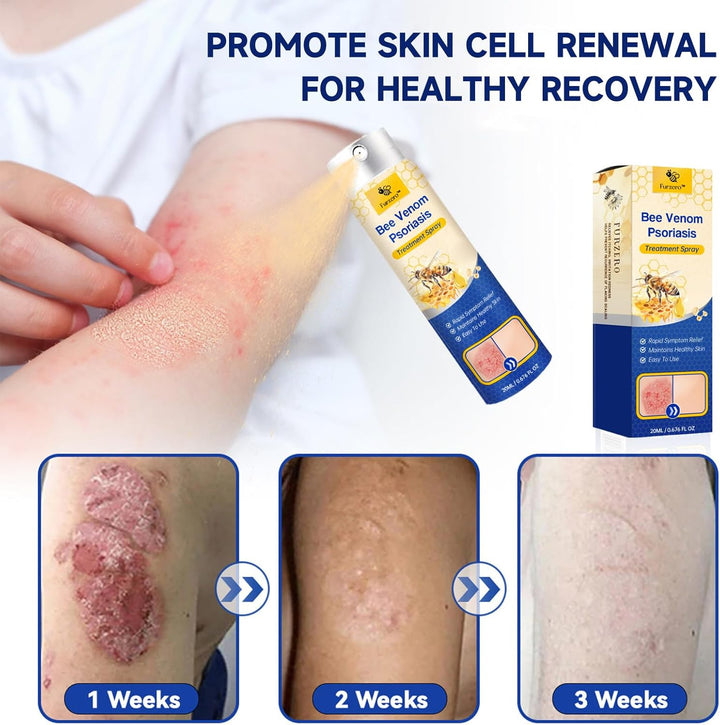 DermaEase psoriasis spray. Hurtig lindring af kløe, rødme og skæl for sensitiv hud. Dermatologisk hudpleje.